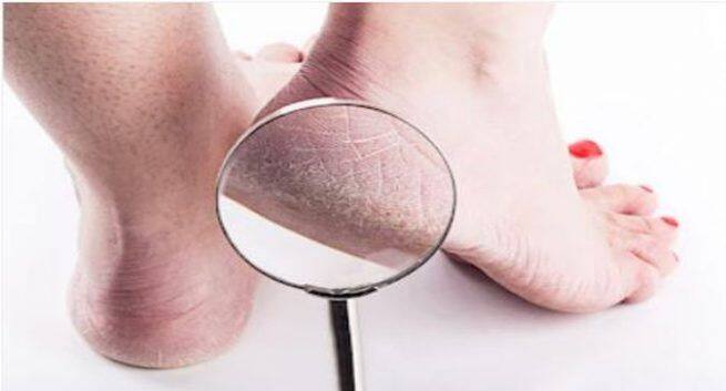 Simple home remedies to soften your cracked heels