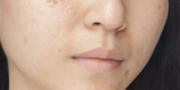 Cure acne naturally at home with these 5 herbal extracts