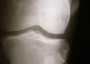 Cartilage - protect it with the right foods | TheHealthSite.com