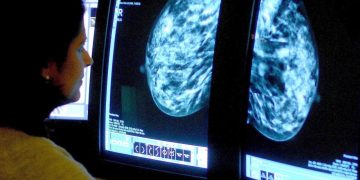 Artificial intelligence programme detects breast cancer better than specialists, study finds